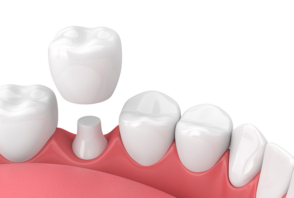 3D dental crown image